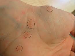 The safety of using ivermectin in children weighing <15 kg has not been well established. Skabies Erfahrungen Aus Der Praxis