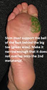 Create A Morton S Toe Shim Morton S Toe Plantar Fasciitis Cure Mind Body Spirit