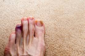 We did not find results for: 110 Bruised Toe Photos Free Royalty Free Stock Photos From Dreamstime