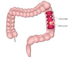 Internal hemorrhoids lie inside the rectum. The Difference Between Colon Cancer And Hemorrhoids