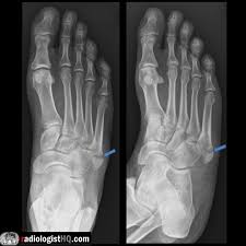 Pseudo-jones fracture on x-ray⁠ : rRadiology