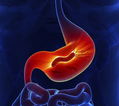 الجرثومة الغازية