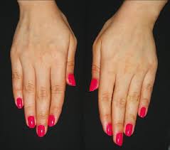 Maybe you would like to learn more about one of these? Indian Journal Of Dermatology Venereology And Leprology Nail Cosmetics