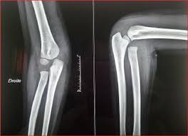 Image result for Radial Head Dislocation