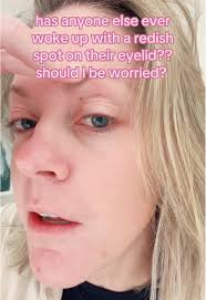 This redish mole freckle thing wasnt there yesterday… Should i be worried😳  #freckles #skinissues #skintok #eyelid #dermatologist #skintokcommunity  #skincare