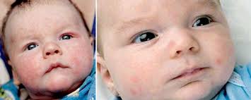 Neurodermitis bei babys und kleinkindern kann vorübergehend sein. Babyhaut Milchschorf Kopfgneis Neurodermitis Co Oko Test