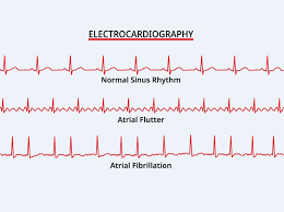 Image result for Atrial Fibrillation Rate Control
