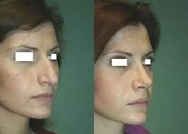 Adobe photoshop adobe photoshop cs6. Correzione Della Gobba Del Naso Estheticon It