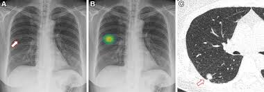 Image result for Chest XRay