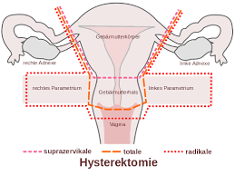 Wie kann man sich das gefühl vorstellen?? Gebarmutterentfernung Hysterektomie Weitere Informationen