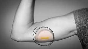 Nov 21, 2019 · the birth control implant (aka nexplanon) is a tiny, thin rod about the size of a matchstick that releases hormones into your body to prevent you from getting pregnant. There S A New Form Of Birth Control On The Market In Nova Scotia Here S What You Need To Know Cbc News