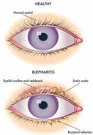 Itchy Eyelids Blepharitis Treatment Top Eye Doctors Specialists In Nyc