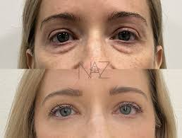 Lower eyelid blepharoplasty with fat transposition, skin pinch, and TCA  butterfly peel ☑️