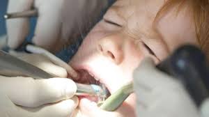 दांत कैपिंग प्रक्रिया के लिए इमेज परिणाम