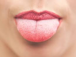 Lie Bumps Transient Lingual Papillitis Tongue Sores Canker Sore On Tongue Canker Sore