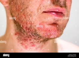 Image result for Beard Dermatitis