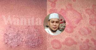 Kulit kepala terasa gatal, berwarna kemerahan, dan bersisik? Air Garam Lada Hitam Penawar Sakit Kulit 3 Hari Kering Sembuh Mingguan Wanita