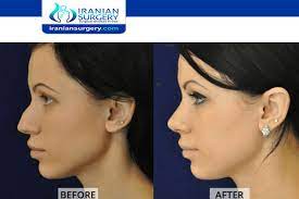 A deviated septum can be medically defined as the misalignment of the nasal septum; How To Fix A Deviated Septum Without Surgery Iranian Surgery