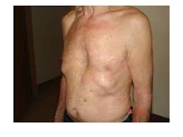 Грудная клетка — это анатомическое образование, которое состоит из грудины, ребер, позвоночника. Obshij Osmotr Bolnogo Shema Obsledovaniya Bolnogo Subetivnoe