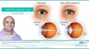 ساد العين كيفية إجراء العملية عيادات السالم لطب و جراحة العين أ د خليل السالم