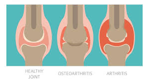 Rheumatoid Arthritis And Osteoarthritis What Is Common And How They Differ From Each Other Sapna Pain Management Blog