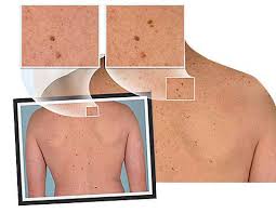 However, the researchers can only hypothesize on the mechanisms driving this association. Mole Clinic London London Dermatology Clinics
