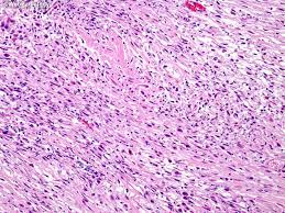 C, biphasic malignant mesothelioma shows a combination of epithelioid and sarcomatoid areas. Webpathology Com A Collection Of Surgical Pathology Images