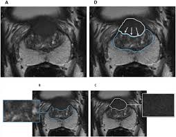 They also do tests to le. Multiparametric Magnetic Resonance Imaging For The Detection Of Clinically Significant Prostate Cancer What Urologists Need To Know Part 2 Interpretation Sciencedirect