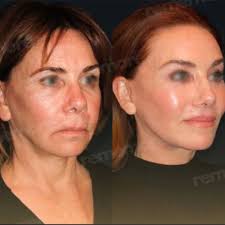 Standard Facelift Surgery All Included