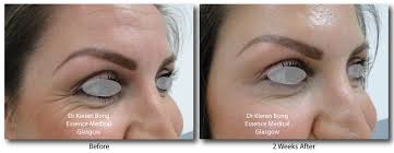 Maybe you would like to learn more about one of these? Botox Brow Lift Is Glasgow S Best Kept Secret