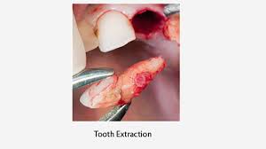I was told to get my wisdom teeth out about five years ago and since i waited so long my wisdom teeth pushed up against the molars they were. How Much Does It Cost To Get Wisdom Teeth Out Nz