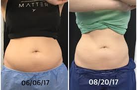 How long after you have botox for migraines do you expect it to start working?does it take a couple of weeks or do you expect it to work straight away. Coolsculpting How Does It Work Reddit Find Coolsculpting Clinics