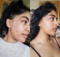 .people using adapalene may consider using the product for longer than 6 adapalene to help improve and prevent the appearance of atrophic scarring. Dermatica For Acne Review Before And After Pictures