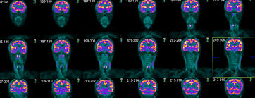 These diseases include cancers, heart disease, endocrine, gastrointestinal or neurological. Brain Pet Scan