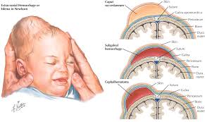 Image result for Vacuum Caput