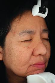 Adult Acne Vulgaris