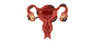بطانة الرحم المهاجرة والحمل ويب طب