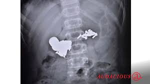 Image result for Pica