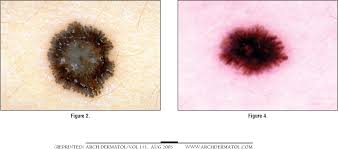 Image result for Spitz Nevus