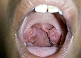 Tonsillectomy