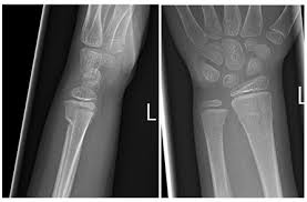 Stress fractures are generally a result of doing too much, too soon, without the body having enough time to adapt. Fracture Education Mcq