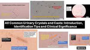 Image result for Urinary Cast