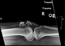 Image result for Fracture XRay