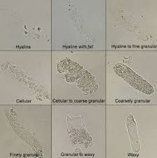 Hyaline Casts In Urine High Clinical Significance Examination Medical Laboratory Medical Technology Labs Clinical Chemistry