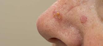 These cells form on the surface of the skin, on the lining of hollow organs in the body, and on the lining of the respiratory and digestive tracts. Squamous Cell Carcinoma Know Its Causes And Treatment