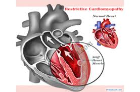 Image result for Restrictive Cardiomyopathy