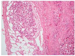 Circulating biomarkers for early diagnosis remain to be identifie … First Reported Finding Of A Malignant Pleural Mesothelioma In A Patient Post Liver Transplant Irish Medical Journal