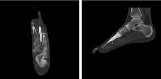 This fracture occurs in a location with less than optimal perfusion and requires a longer healing time. Cureus Is Use Of Bone Cement For Treatment Of Second Metatarsal Stress Fractures Safe A Case Report