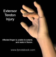 ‐ lr = 49 waeckerle jf. Soft Tissue Injuries Of The Hand Rcemlearning
