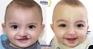 Volunteer trips, supplies aid 'life-saving' cleft palate surgeries